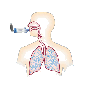 Wirkmechanismus mit AeroChamber Inhalationshilfe